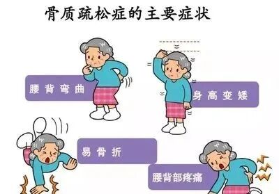 世界骨质疏松日|体重过低、过高，这里都会变“脆”！
