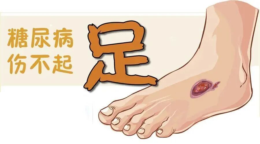 【健康小课堂】摸一摸脚背，远离糖尿病足！糖友们必学的“足背动脉”自检法