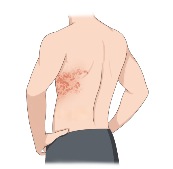 5.8带状疱疹.png 5.8带状疱疹.png